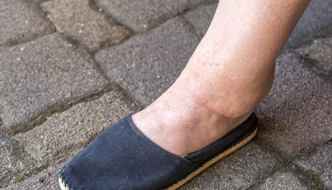 swollen ankles