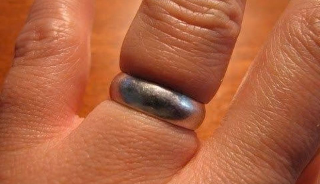 stuck ring on swollen finger
