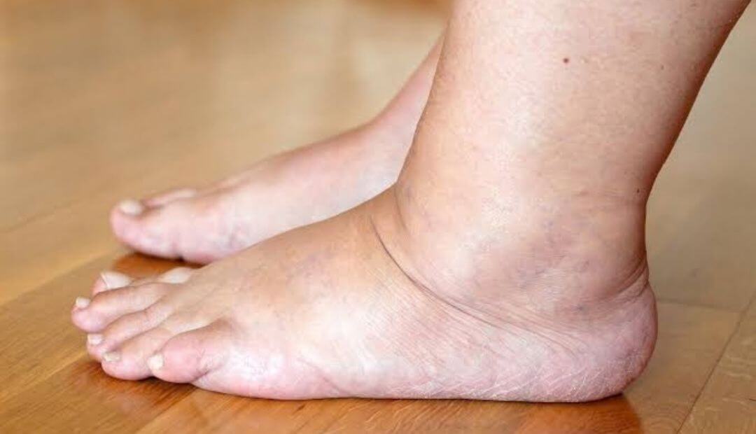 Water Retention: Common Signs, Possible Causes, and What to Know