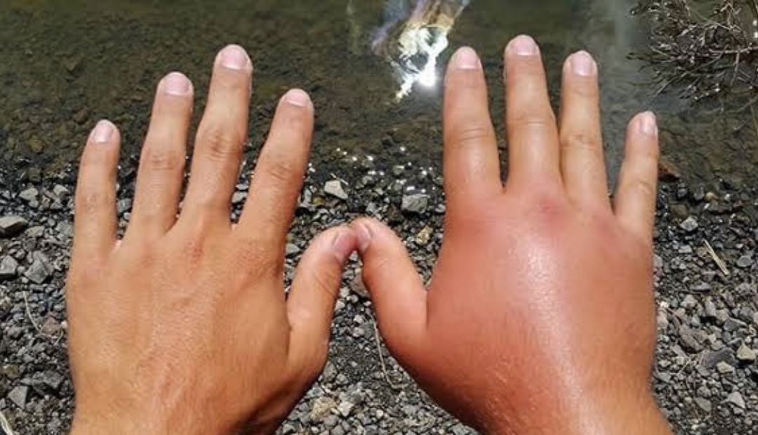 swollen hands and fingers