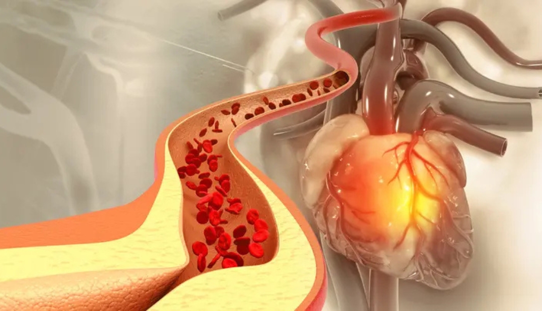 Your LDL Cholesterol Is Normal, But Is Your Heart Health Really Protected?
