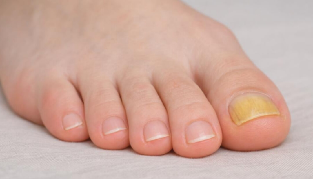 yellow toenails