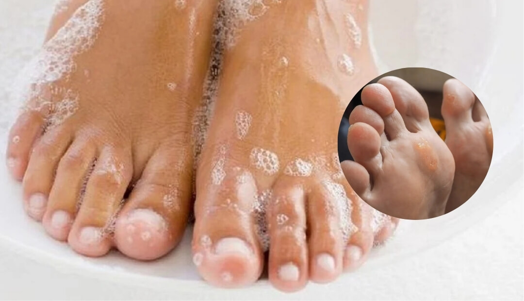 how to prevent toenail fungus