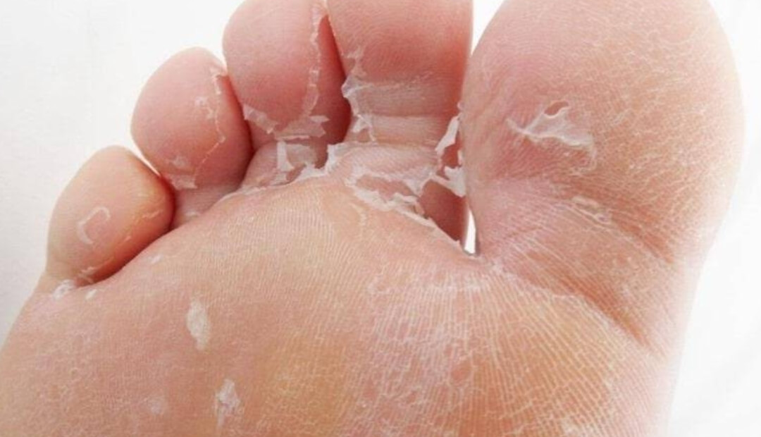 dead skin between toes