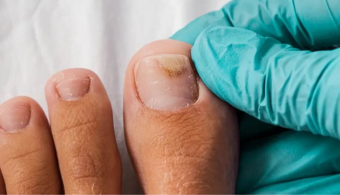 Why Is Your Toenail Separating From the Nail Bed? Causes and What to Do Next toenail separating from nail bed