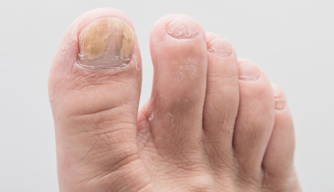 how long does it take for a toenail to grow back