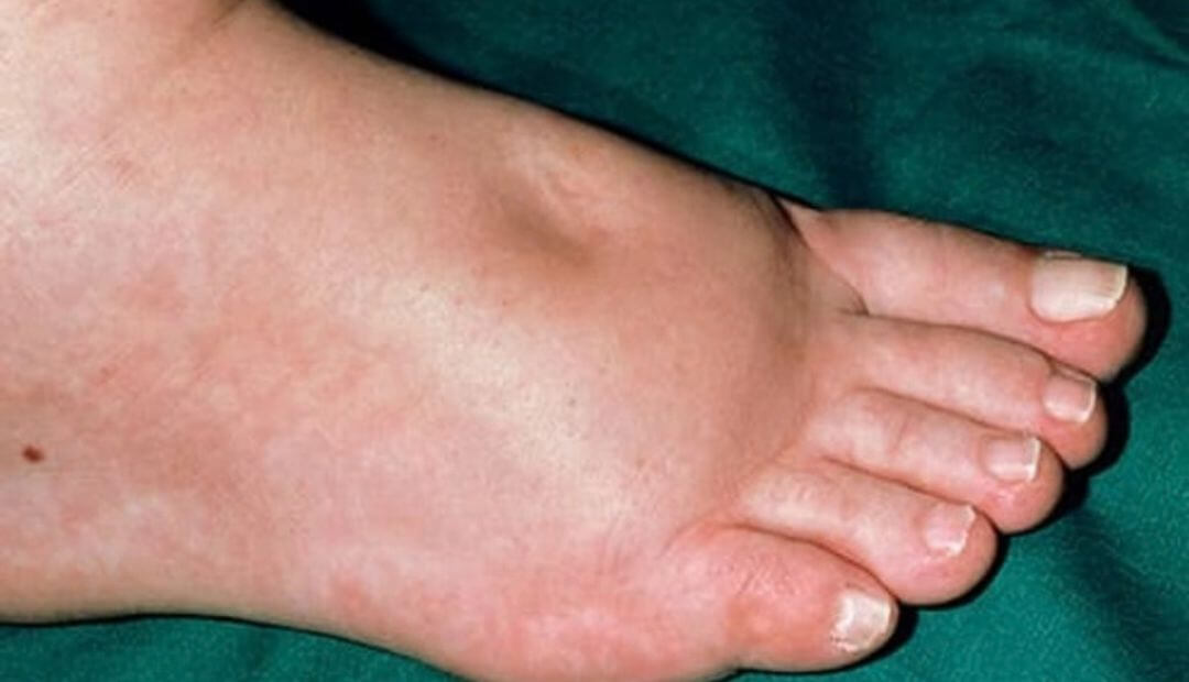 Why Do Your Puffy Feet Look Worse at Night? The Overlooked Fluid Clue