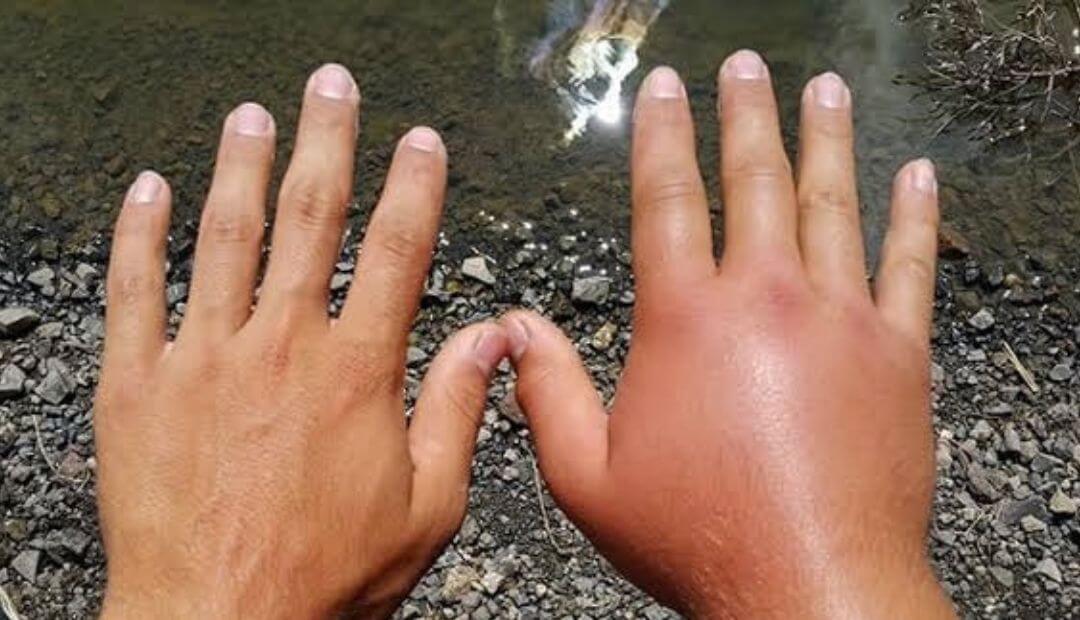 Swollen Hands and Fingers: 7 Causes You Shouldn’t Ignore