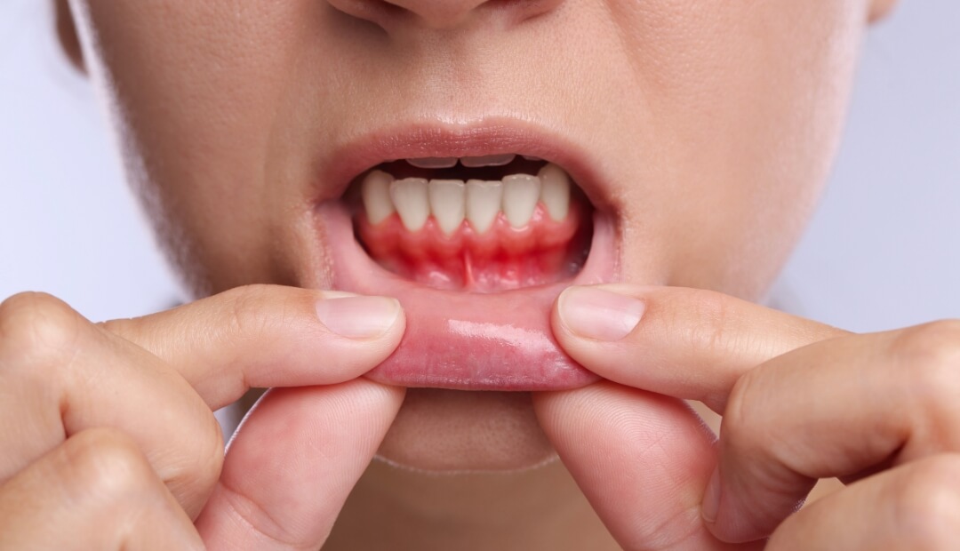 bleeding gums
