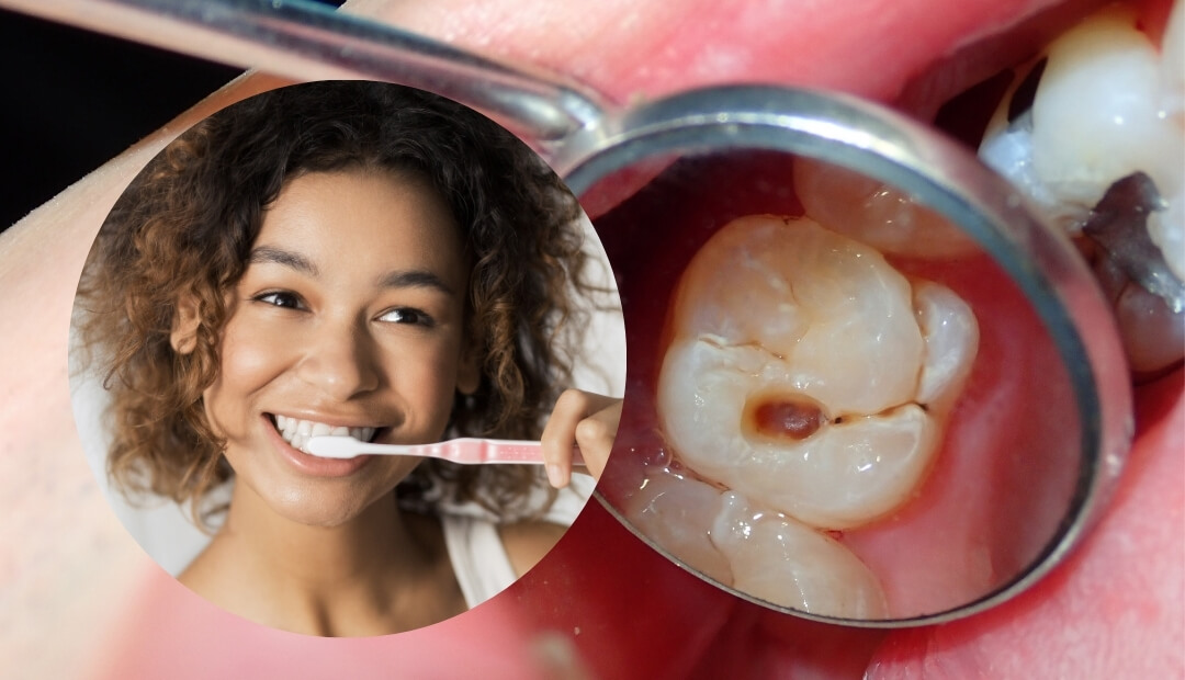 dental plaque