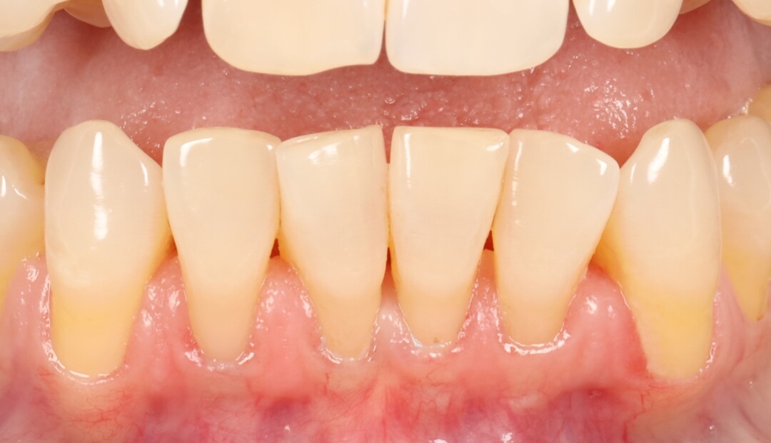 gum recession
