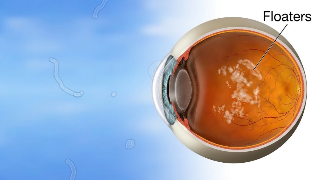 eye floaters causes
