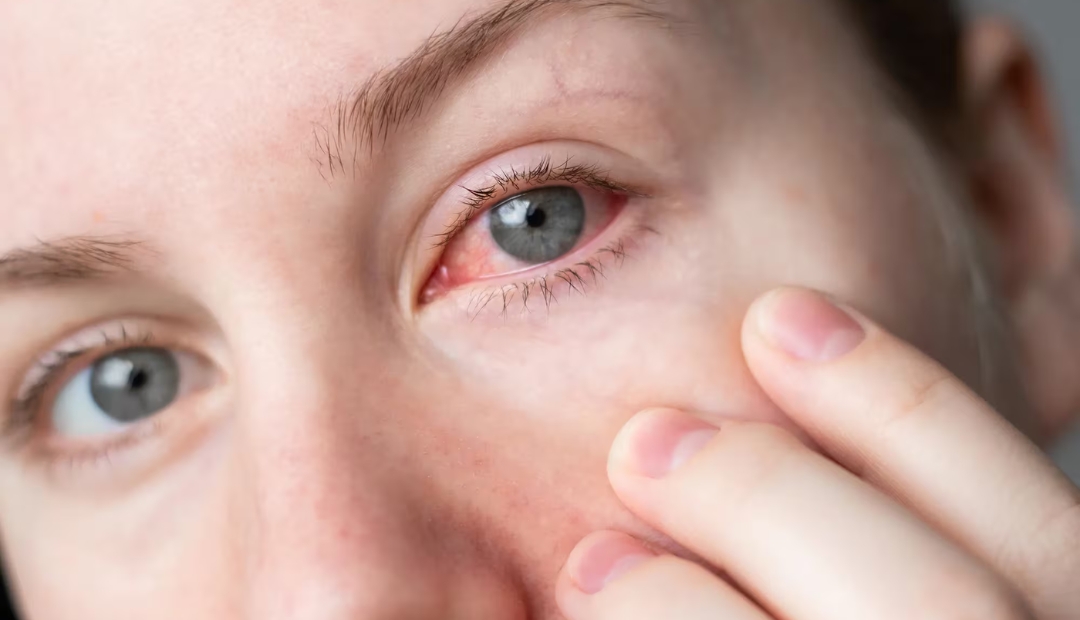 dry eyes symptoms